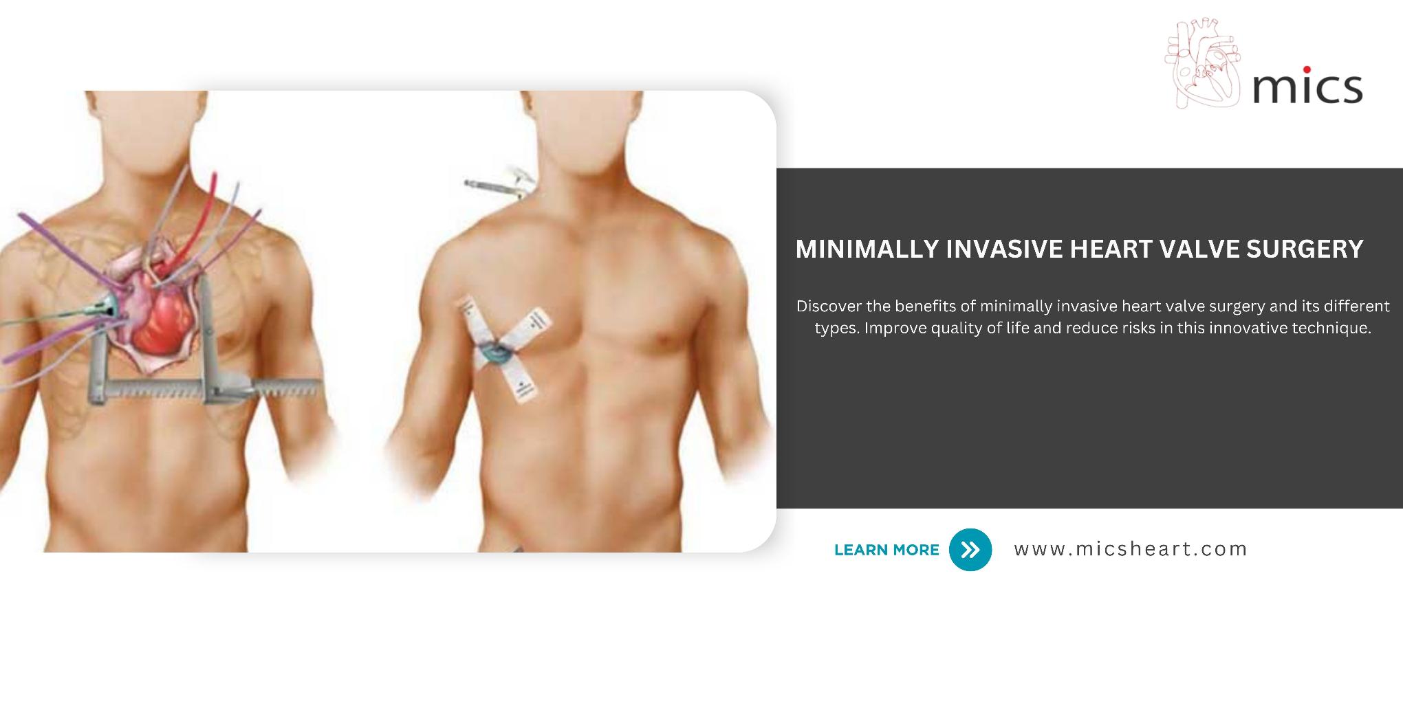 Minimally Invasive Heart Valve Surgery
