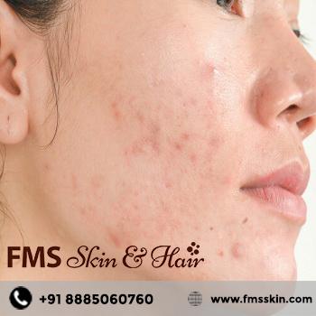 Best Dermatologist In Hyderabad