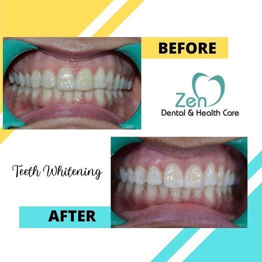 Best Teeth Whitening Service in Sarjapur Road, Bangalore