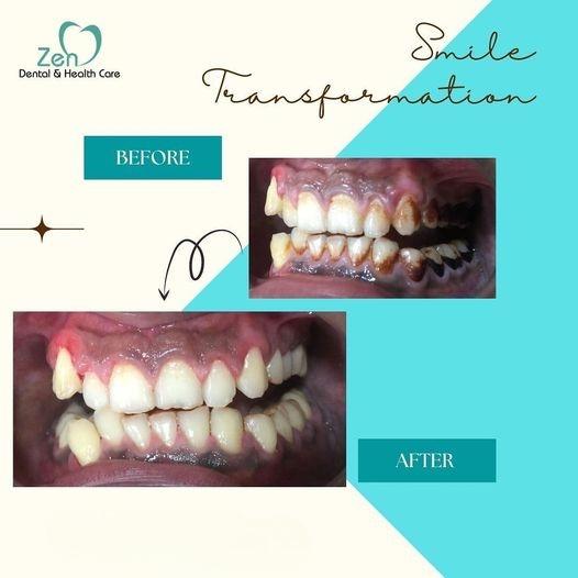 Best Dental Cleaning in Sarjapur Road Bangalore Bangalore