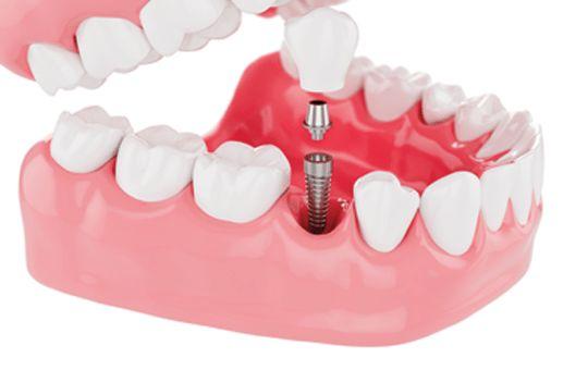 Dental Implants clinic in Ahmadabad | 9825158578