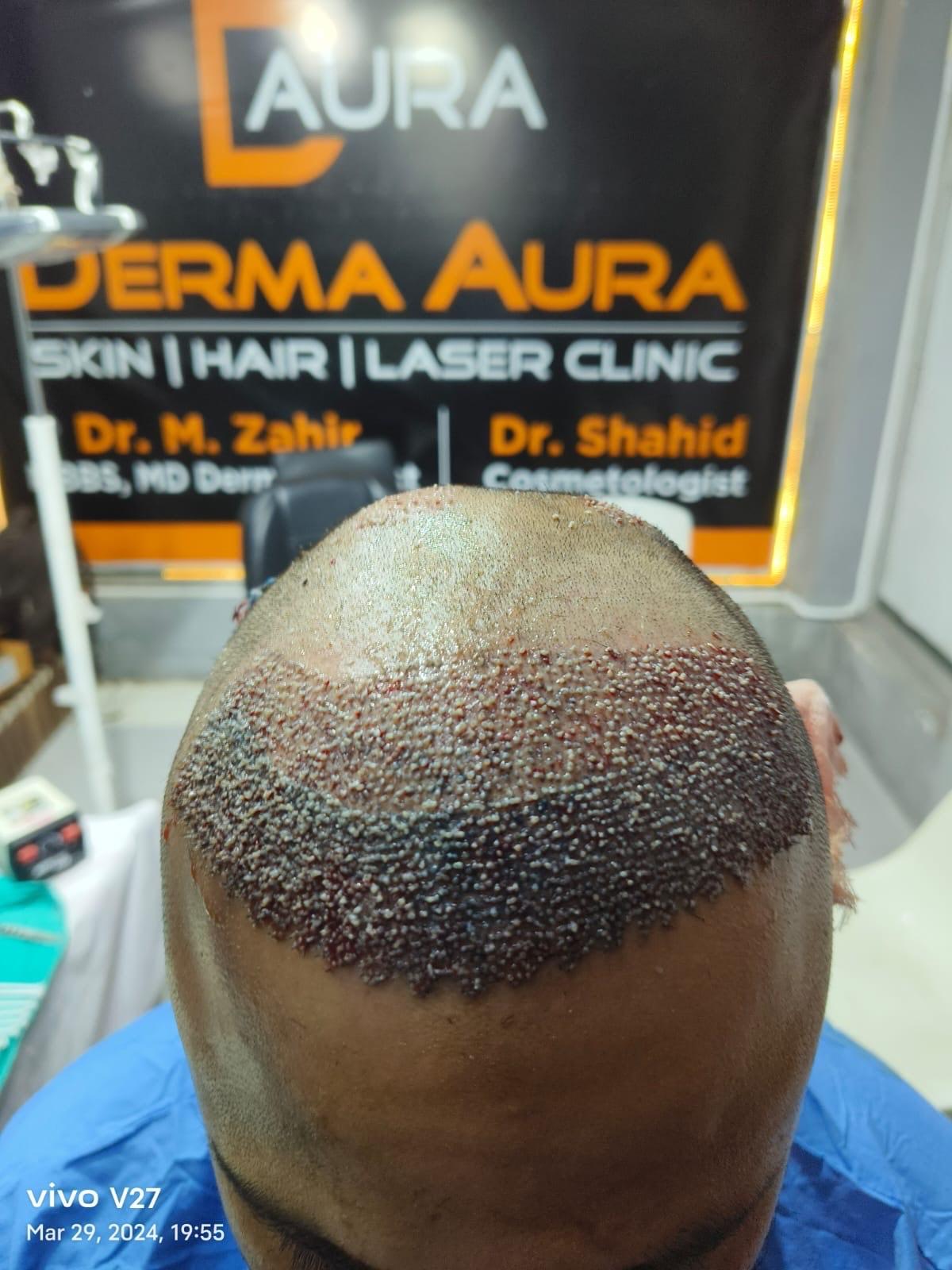 Hair transplant for baldness to change your look 