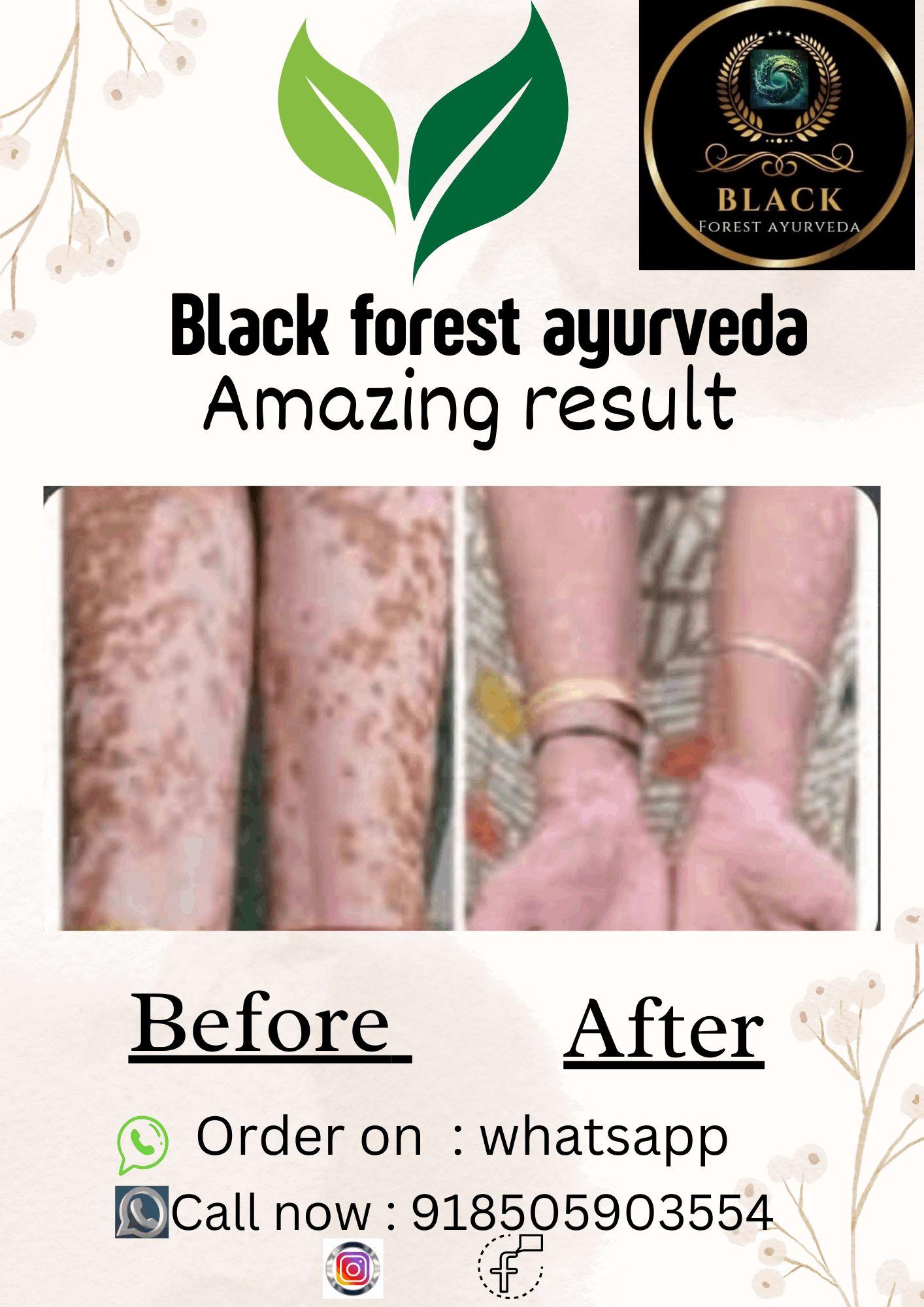 Vitiligo,leucoderma,safeed.daag,other