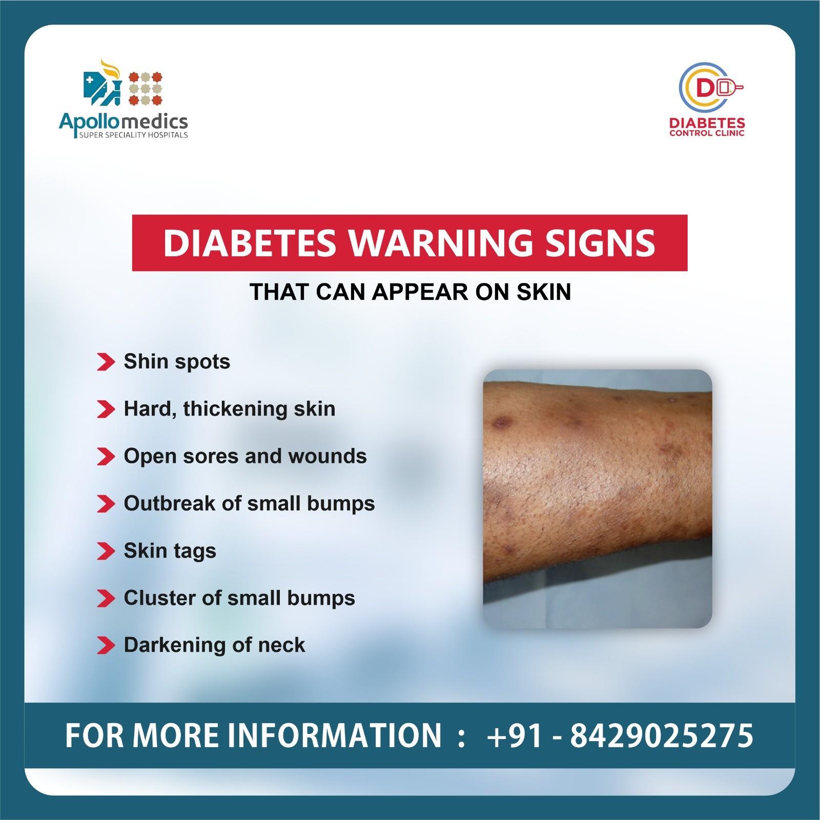 Early Signs of Diabetes? Get Expert Care!
