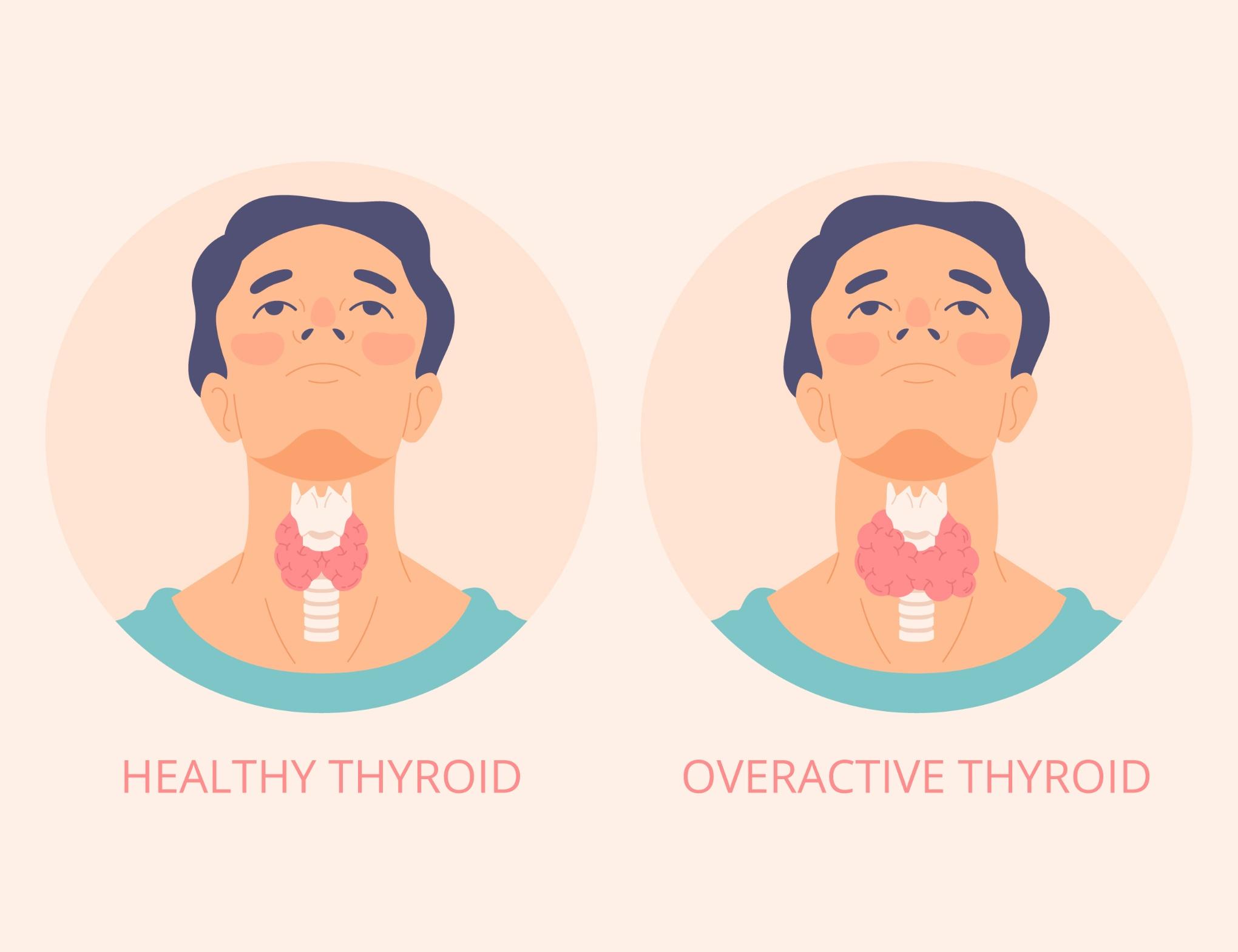 Ultimate Guide to Thyroid Disorders: Symptoms, Diagnosis, and Treatment