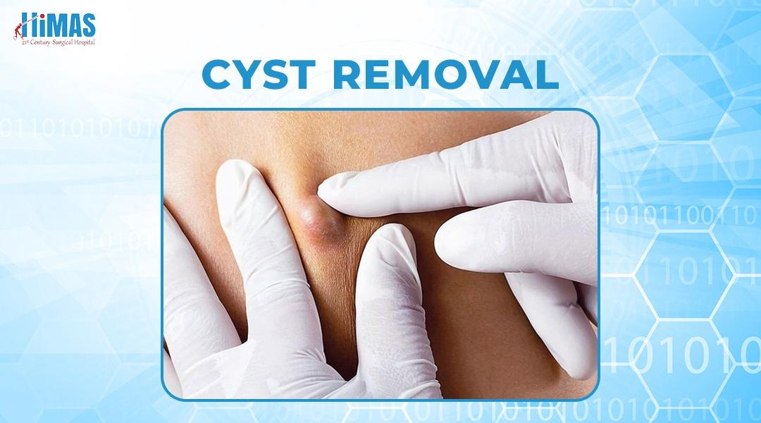 Best Cyst Removal Services in Basavanagudi Bangalore:Himas Hospital