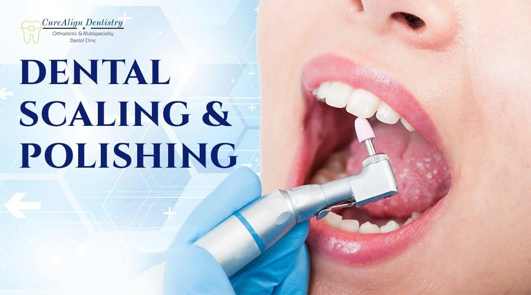 Dental Scaling and Polishing in Hennur Bangalore-CureAlign Dentistry