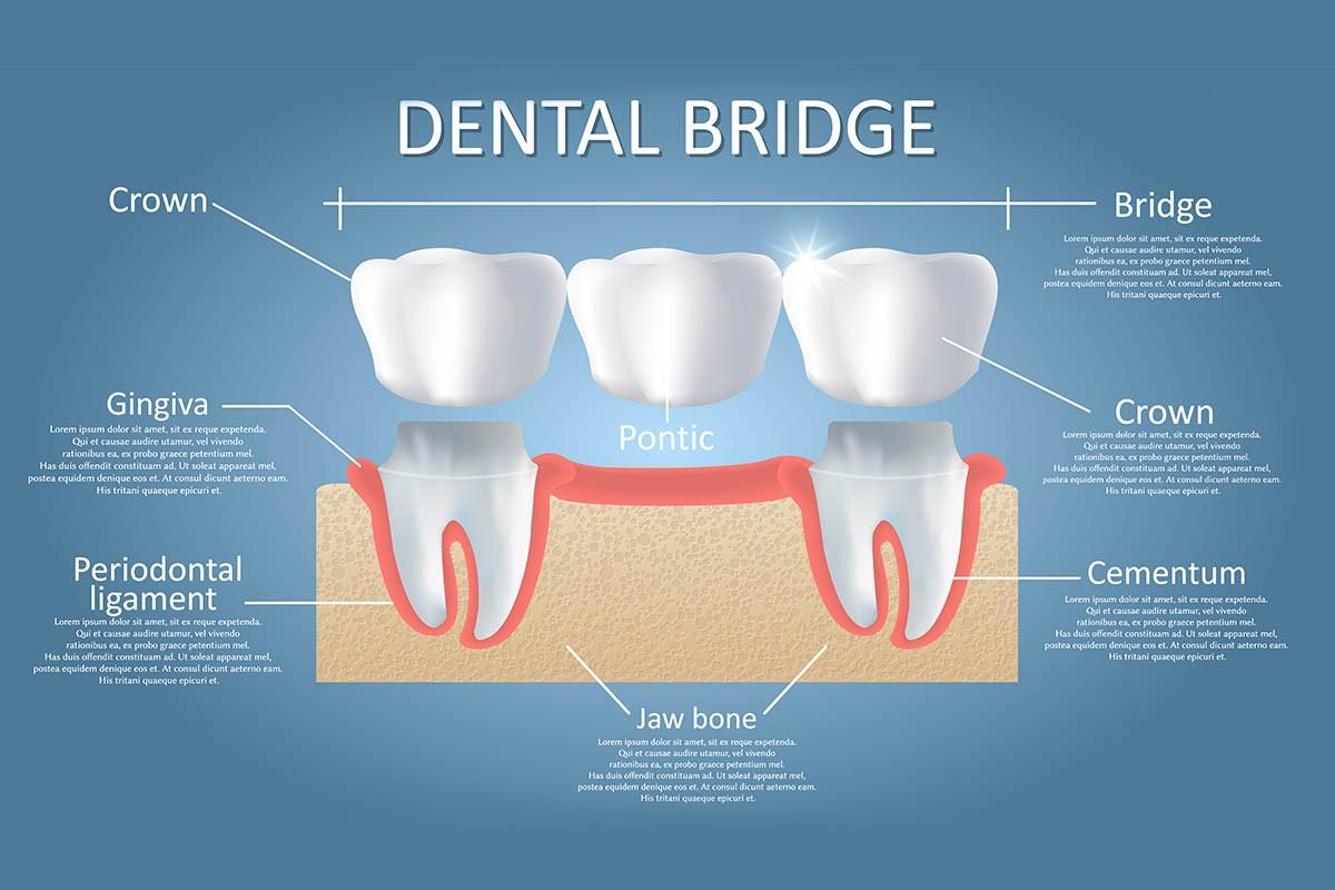 Crowns and Braces in BTM 2nd Stage, Bangalore  Perfect Dental Studio