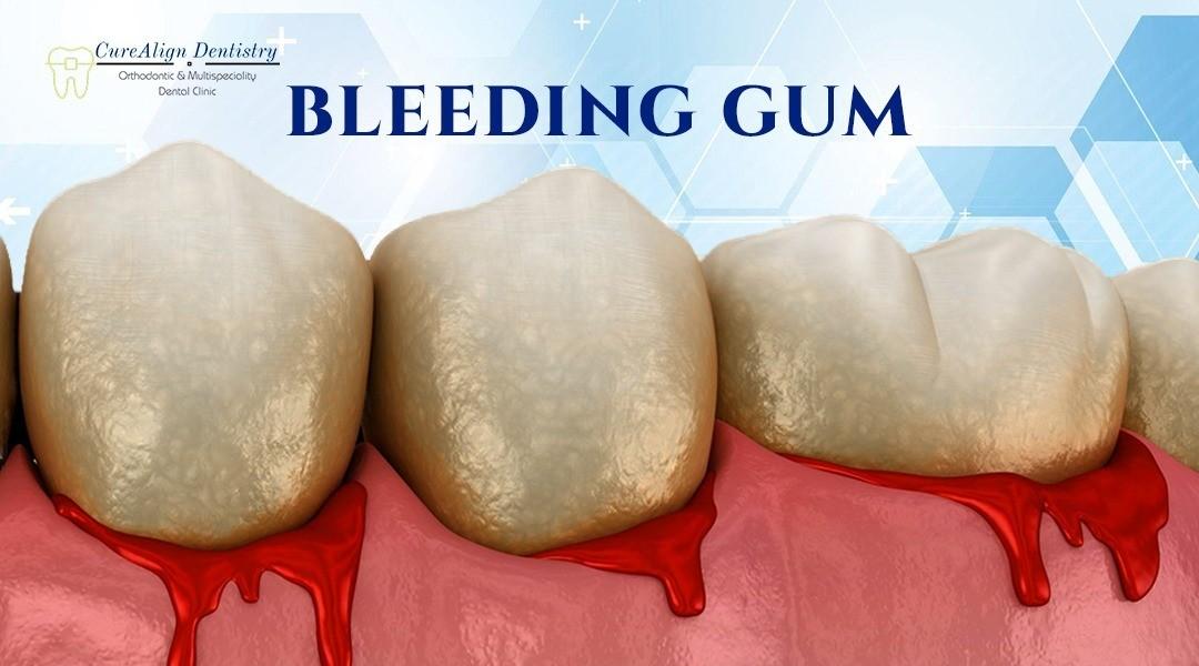 Best Gum Treatment in BTM 2nd Stage Bangalore  Perfect Dental Studio