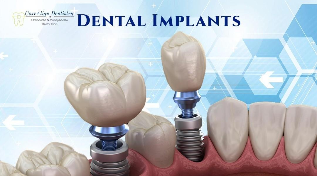 Best Dental Implants in BTM Layout Bangalore Perfect Dental Studio
