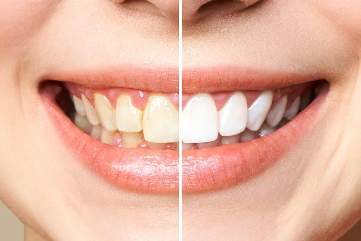 Best Teeth Whitening in BTM Layout Bangalore  Perfect Dental Studio