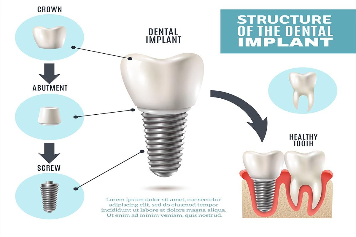 Dental Implants Laser Treatment in BTM Layout Bangalore Perfect Dental Studio
