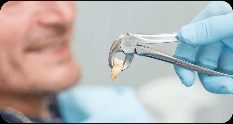 Pain-Free Tooth Extractions by Top Doctor at The Smile Spa, Andheri West