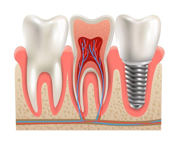 Top Root Canal treatments in Madhapur