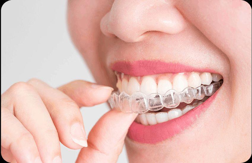  Dental Braces Treatment: Removal, Recovery, and Expert Care at The Smile Spa