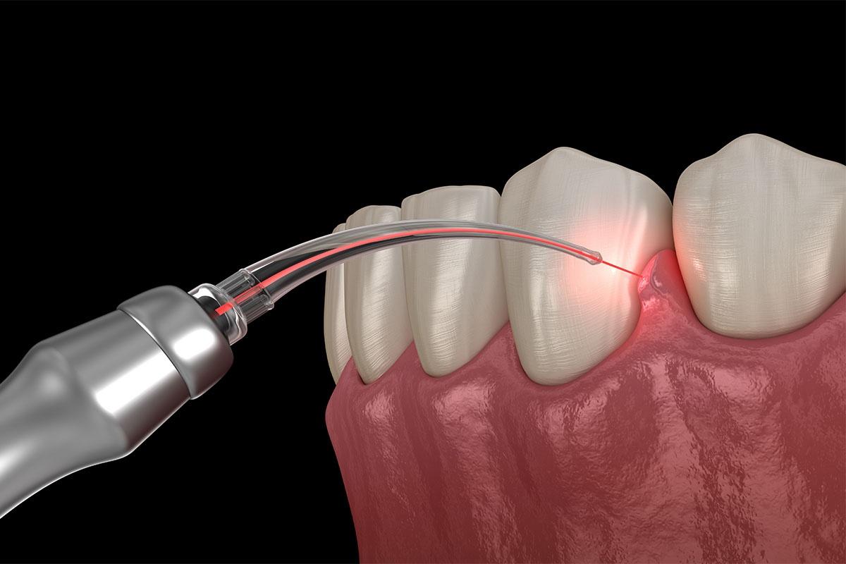 Laser Treatment in BTM Layout Bangalore - Perfect Dental Studio