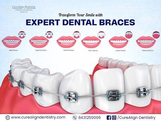 Dental Braces in Hennur Bangalore at CureAlign Dentistry