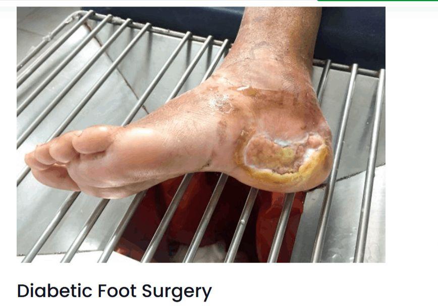 Diabetic Foot Surgery in Basavanagudi Bangalore - Himas Hospital