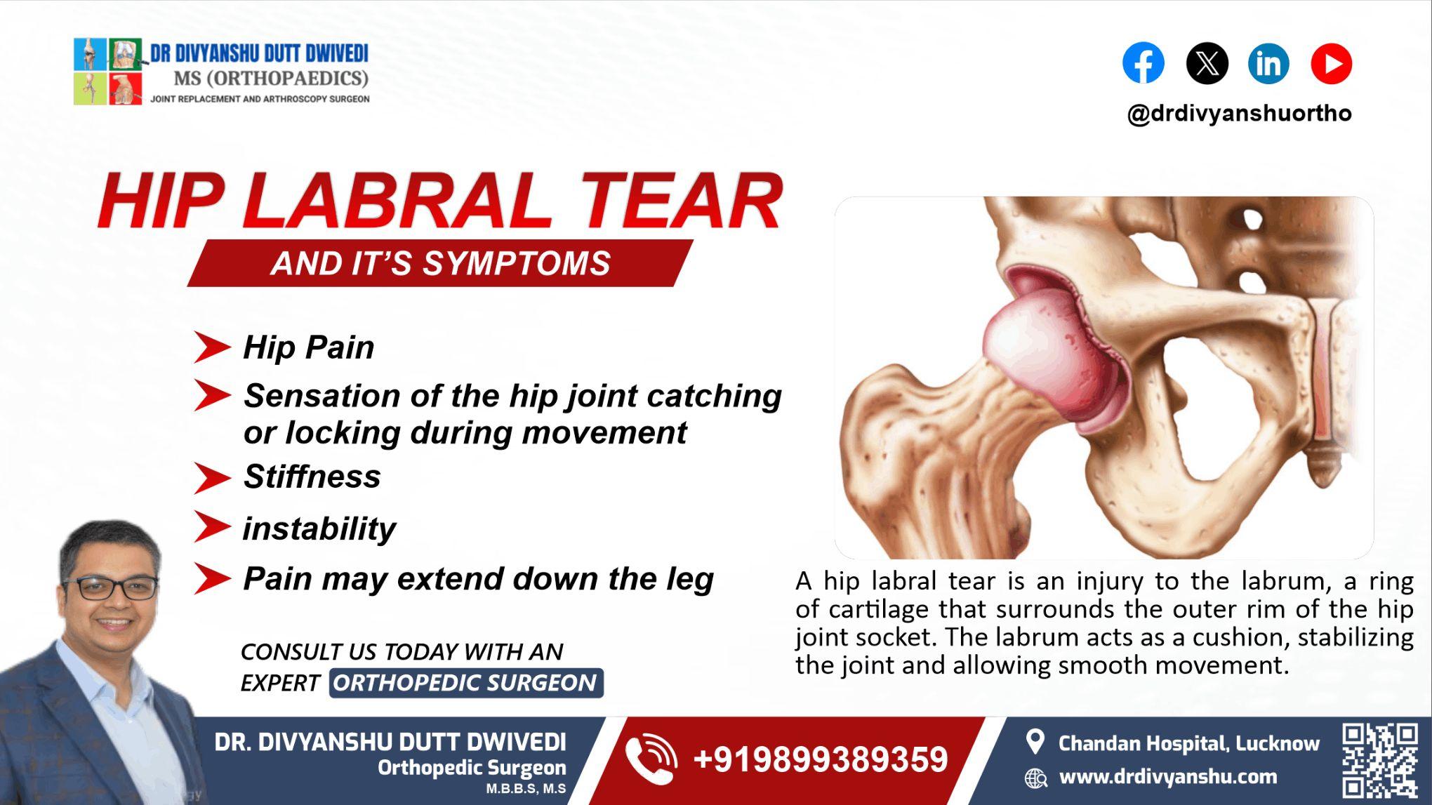 Hip Labral Tear and Its Symptoms: