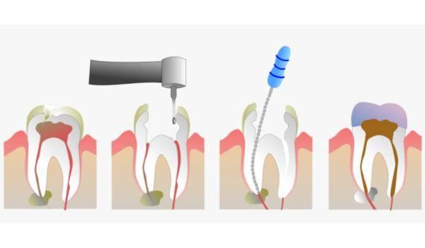 Root Canal Treatment in Hennur, Bangalore: Cure Align Dentistry