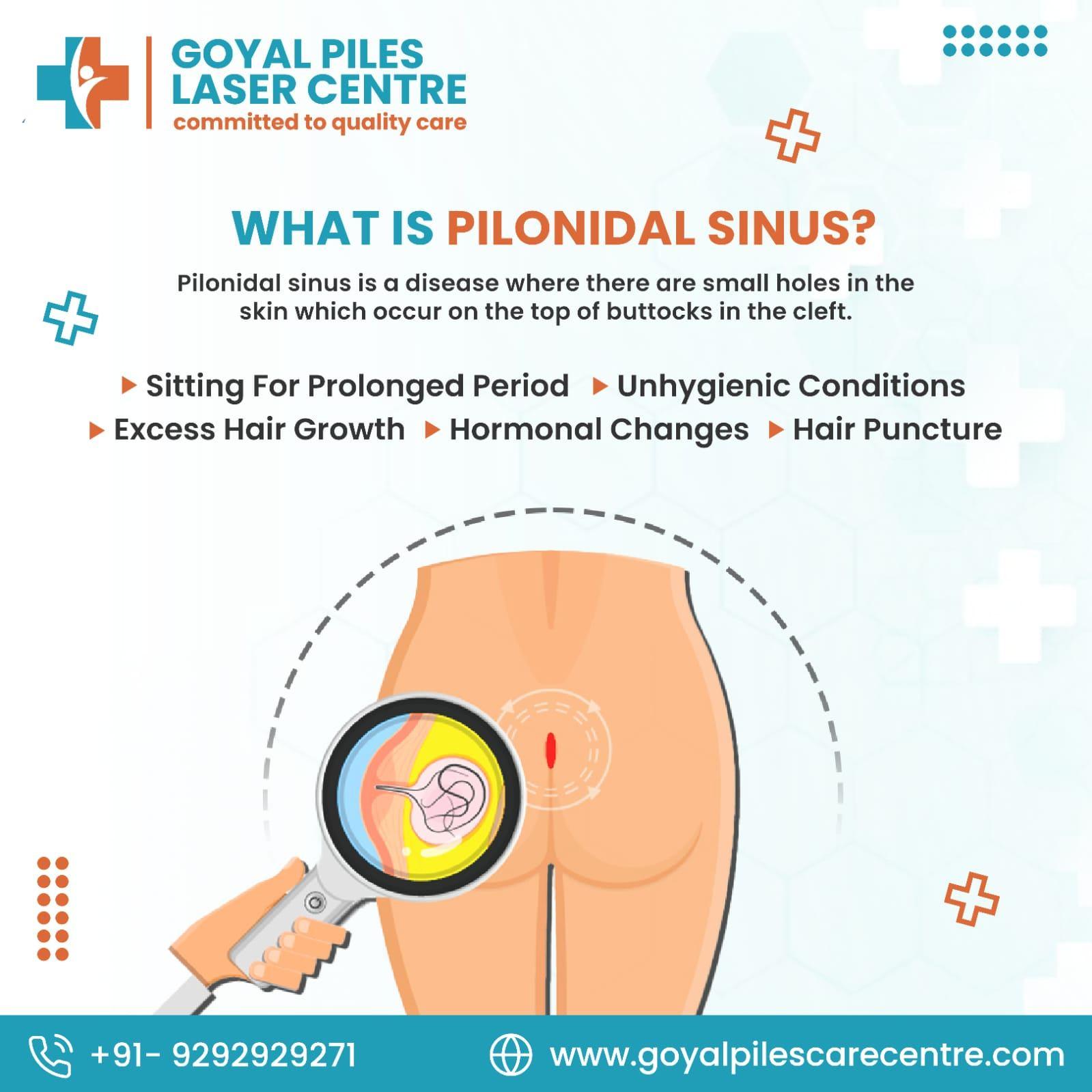 Anal Fissure Surgery |  Goyal Piles Laser Centre