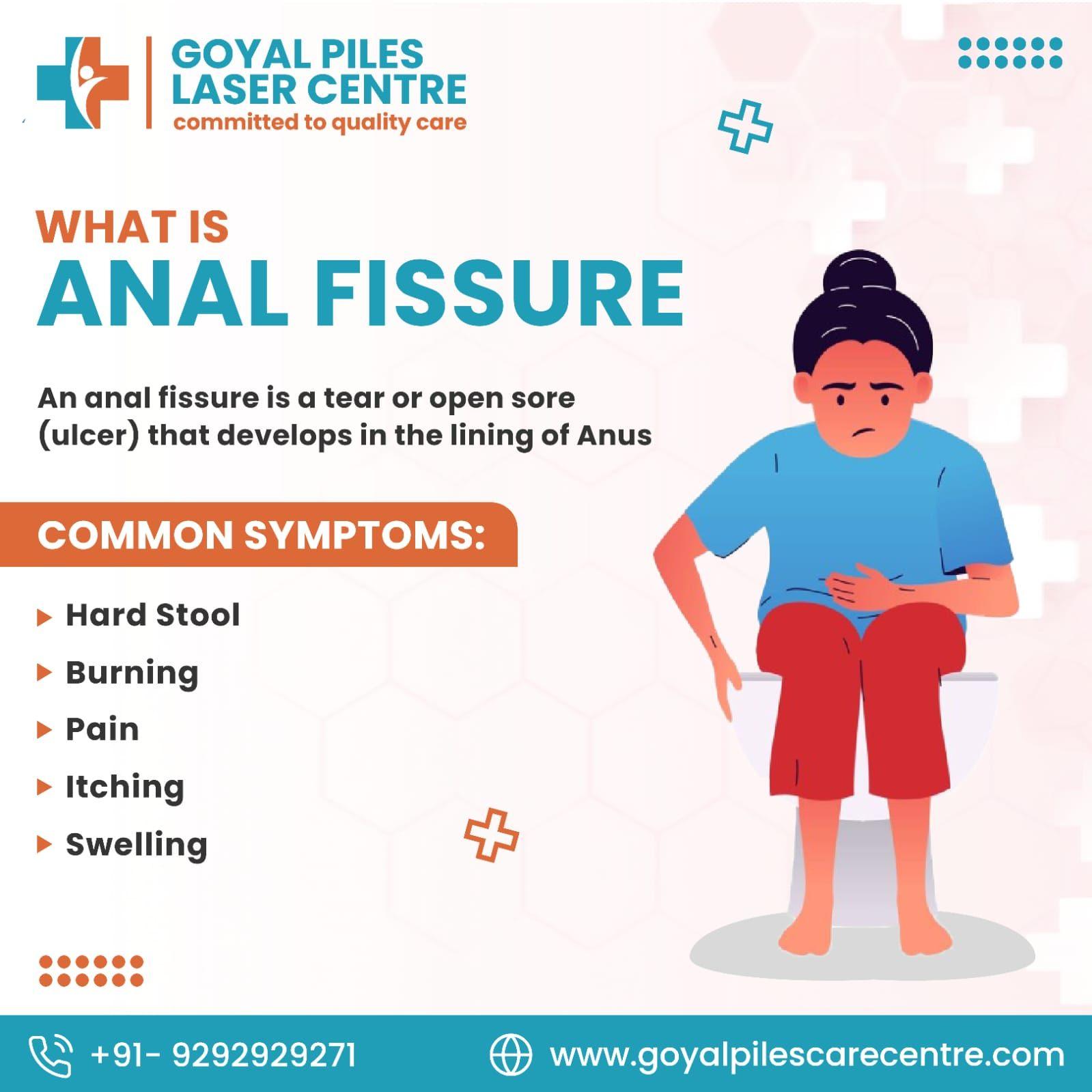 Top Piles Specialists Near Me | Expert Hemorrhoid Care 