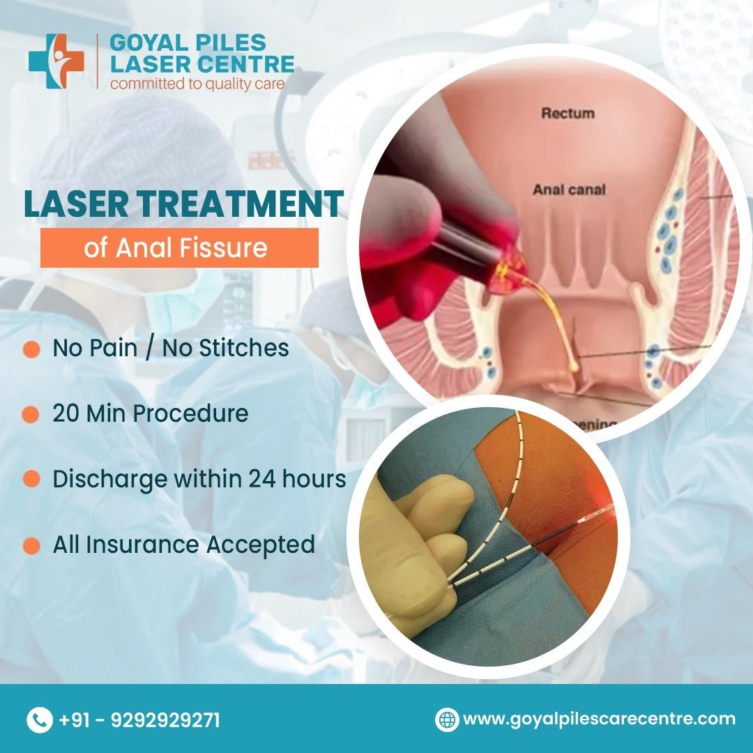 Piles without Surgery | Goyal Piles Laser Centre