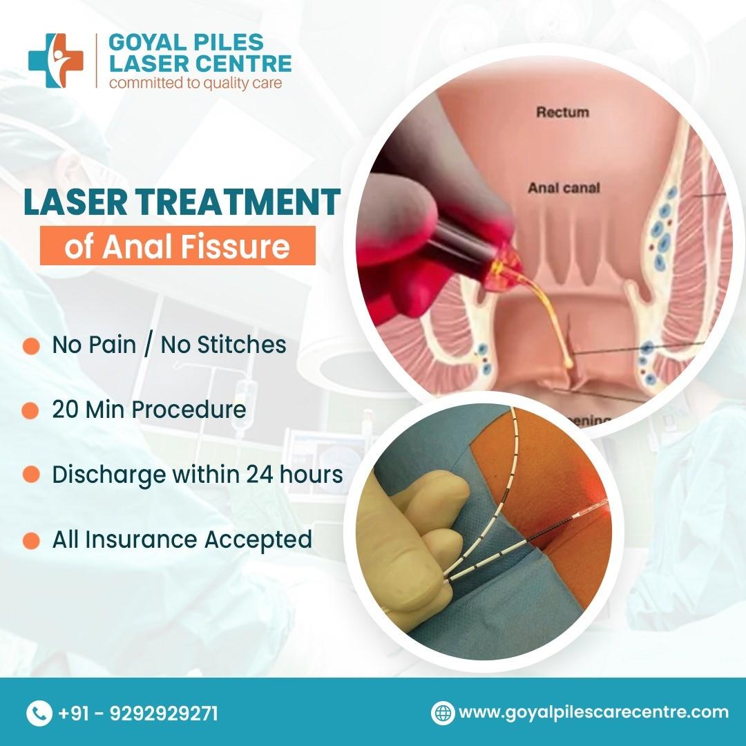  Piles Specialists Near Me | Expert Hemorrhoid Care | Goyal Piles Laser Centre