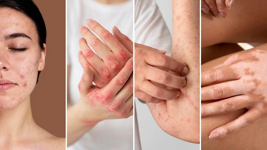 Homeopathic Clinic for Skin Treatment in Surat