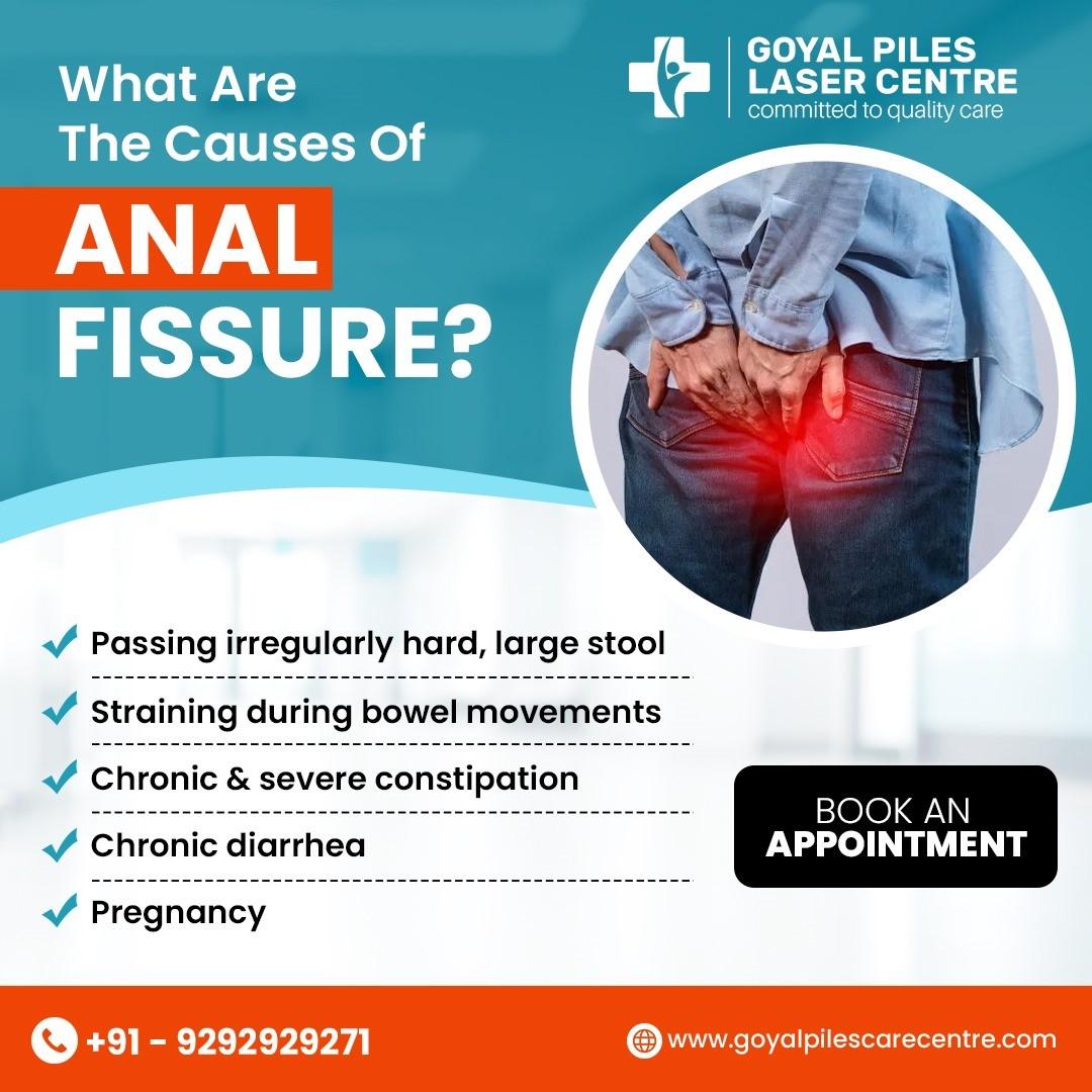  Best Piles Doctor Near Me |Goyal Piles Laser Centre