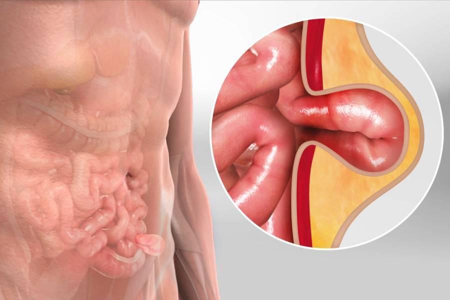 Hernia Surgeon in Chennai  Dr. S. Srivatsan Gurumurthy