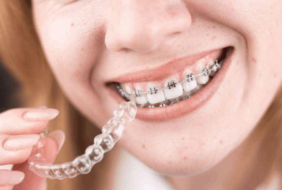 Clear Alignment for the Perfect Smile