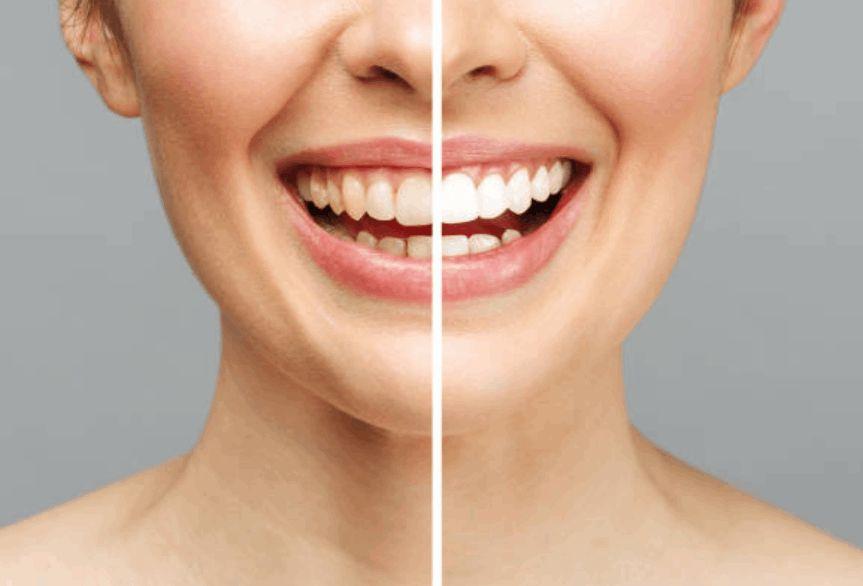 Transform Your Smile with Smile Designing