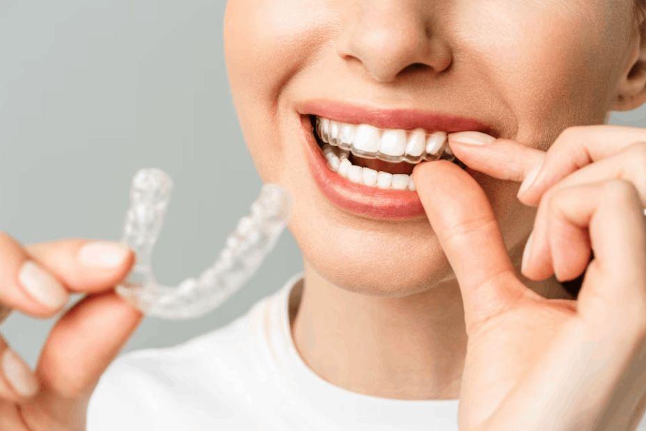 Invisalign Treatment for a Perfect Smile