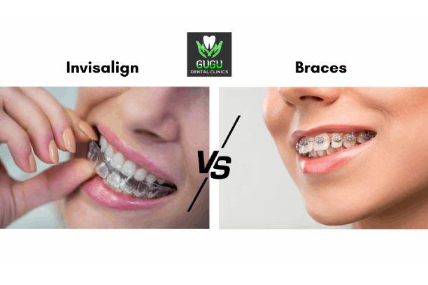 Invisalign vs Traditional Braces: The Best Choice for Adults