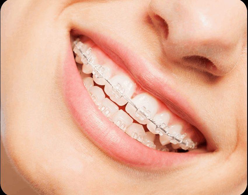 Get Perfectly Aligned Teeth Advanced Teeth Aligners in Vile Parle East