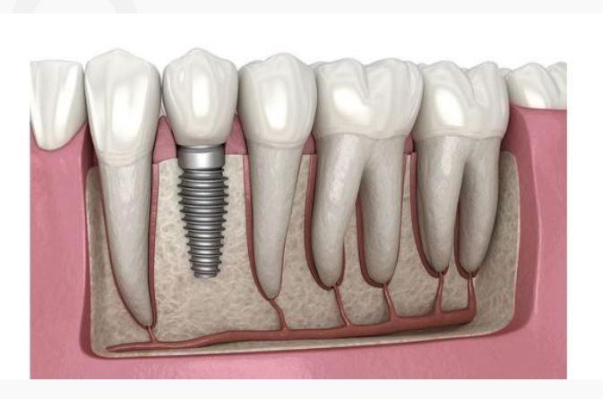 Dental Implants Services in Hennur Bangalore -  CureAlign Dentistry