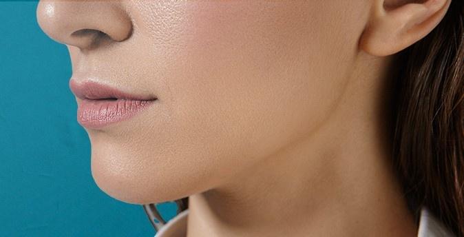 Chin Implant Surgery in Chennai | Sculpt Your Jawline at Kosmoderma