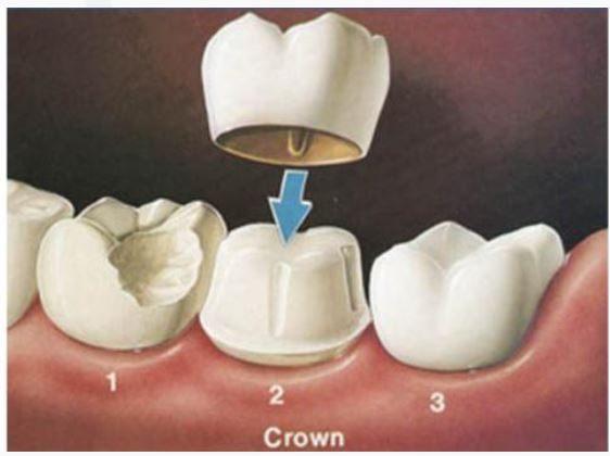 Dental Crowns and Bridges Treatment in Hennur, Bangalore