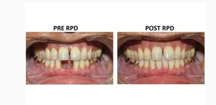 Removable Denture in Hennur, Bangalore - CureAlign Dentistry