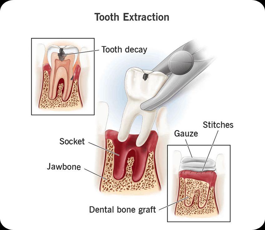 Tooth Extraction Experts Near You in Juhu  Trusted by Locals at The Smile Spa
