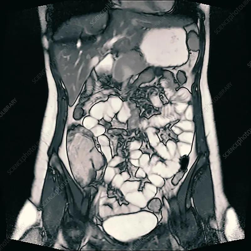 CT Enterography in Navi Mumbai