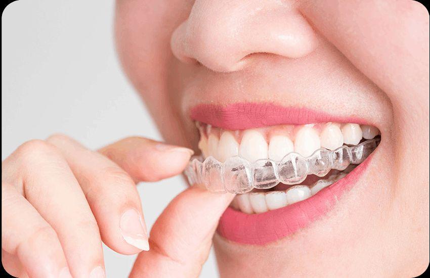 Smile Confidently with Affordable Braces at The Smile Spa