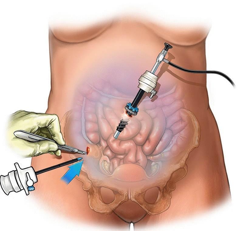 Advance Laparoscopy Training in India: World Laparoscopy Hospital
