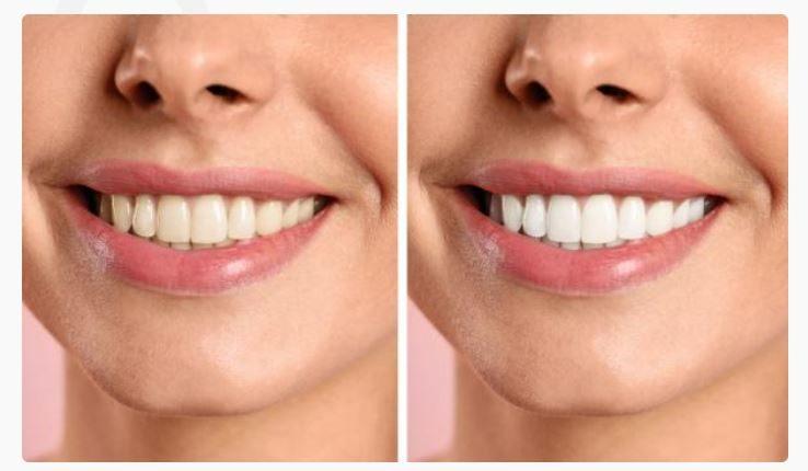 Teeth Whitening/Bleaching in Hennur, Bangalore - CureAlign Dentistry