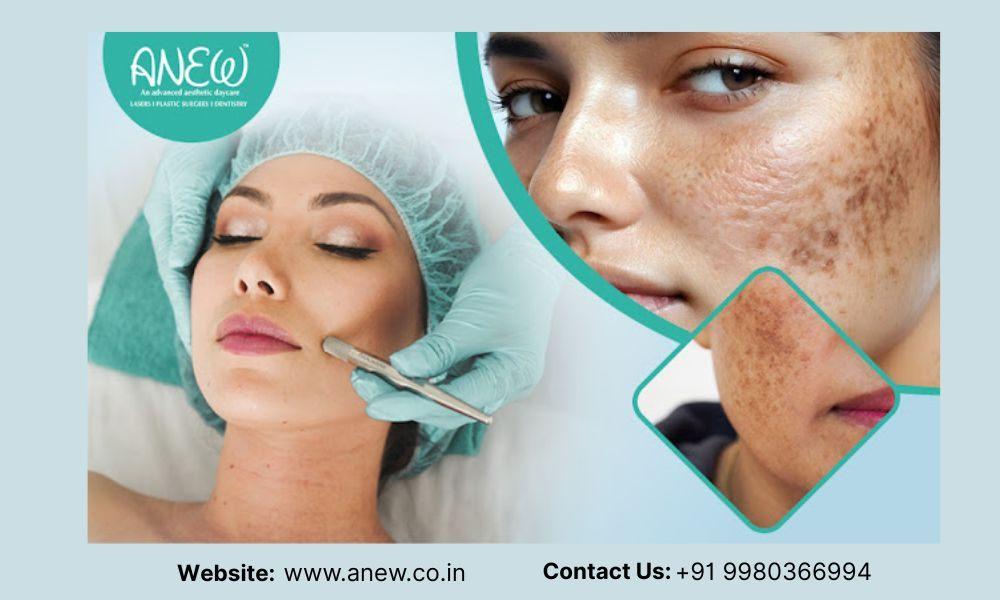 Hyperpigmentations Treatment in Bangalore: Anew Cosmetic Centre