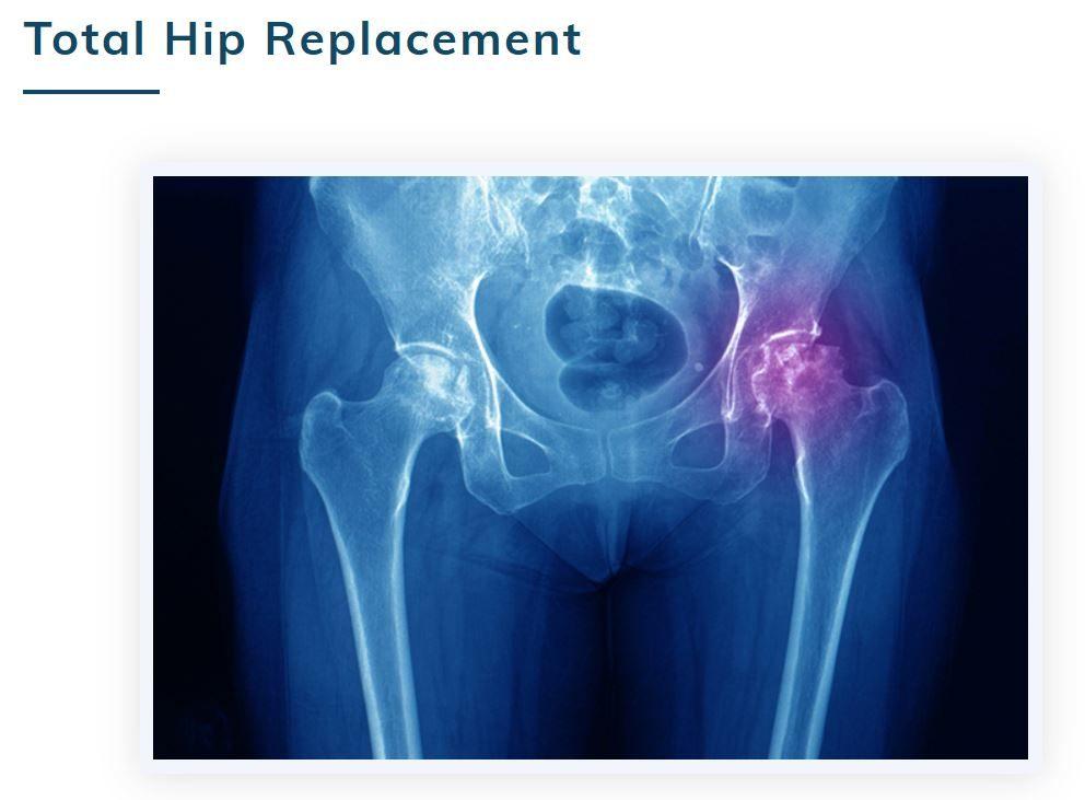 Total Hip Replacement in Koramangala, Bangalore - Dr. Rewat