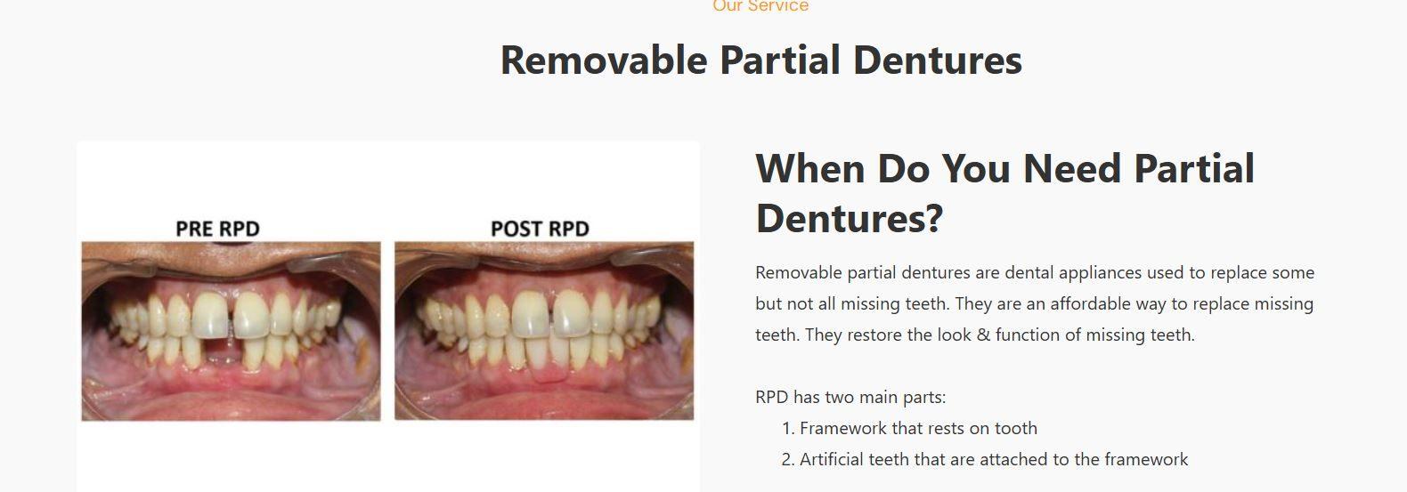 Removable Partial Dentures in Hennur, Bangalore - CureAlign Dentistry