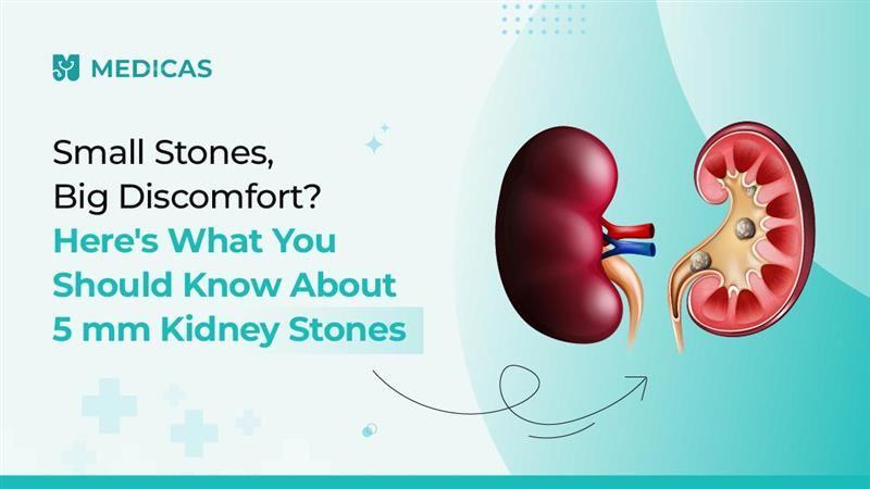 How to Manage a 5 mm Kidney Stone: Complete Guide for Patients
