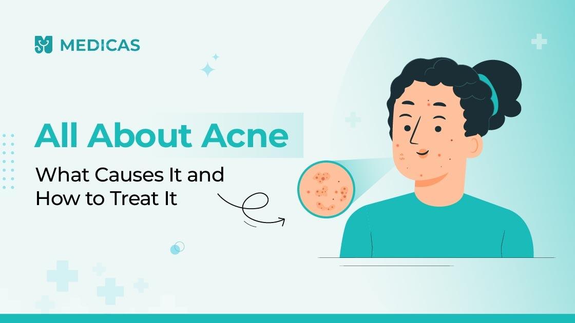 Acne Demystified: Causes, Treatments & Myths Busted